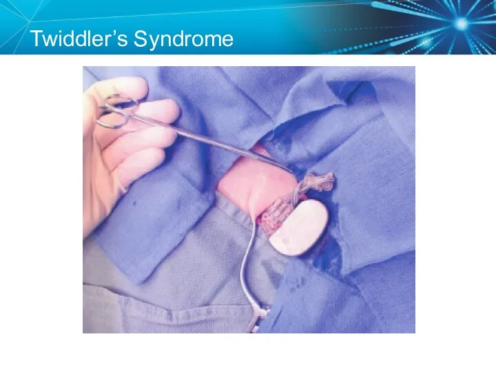 Twiddler’s Syndrome