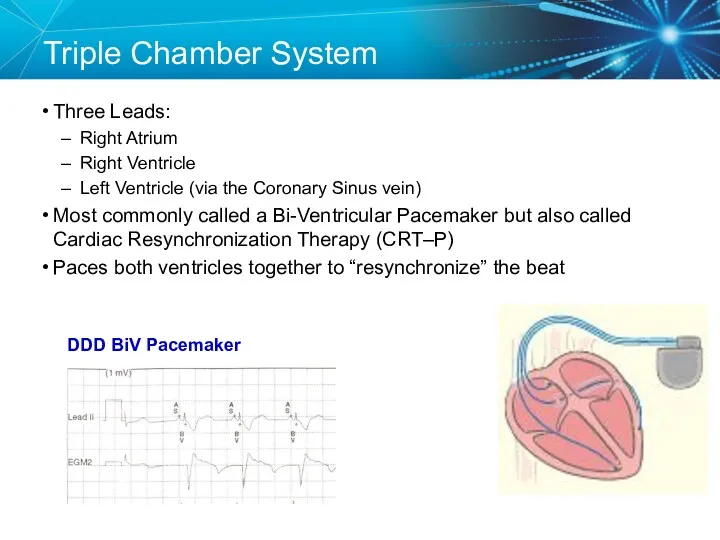 Triple Chamber System Three Leads: Right Atrium Right Ventricle Left