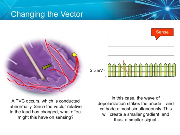 Changing the Vector Sense A PVC occurs, which is conducted