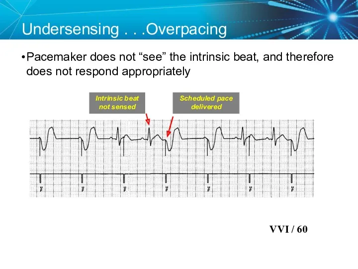 Undersensing . . .Overpacing Pacemaker does not “see” the intrinsic