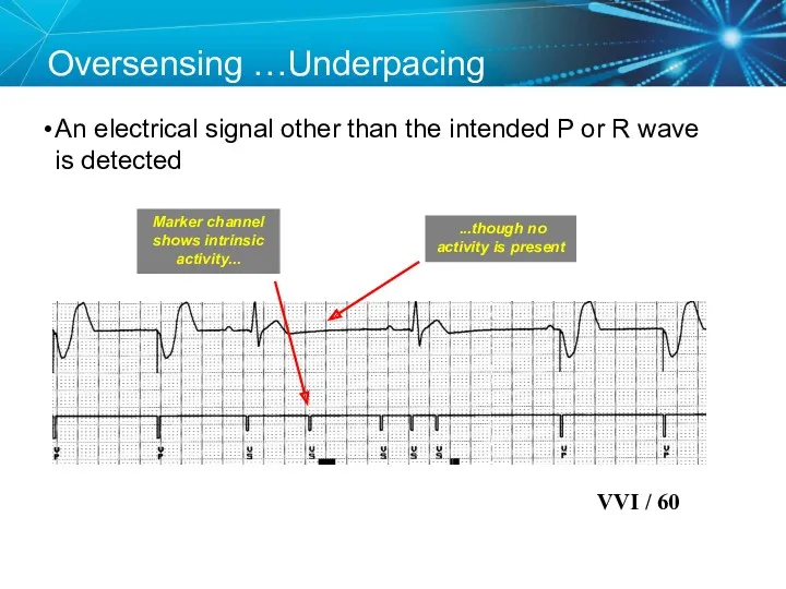 Oversensing …Underpacing An electrical signal other than the intended P