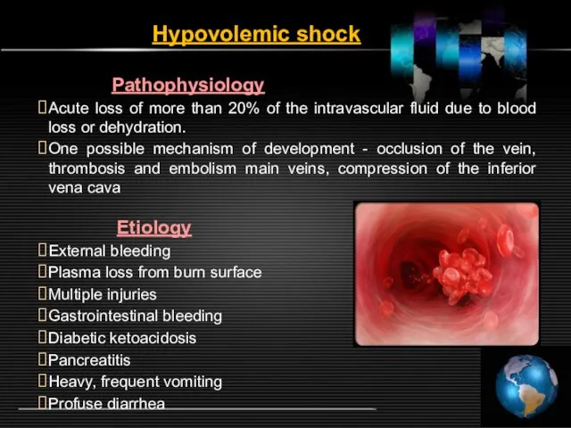 Hypovolemic shock Pathophysiology Acute loss of more than 20% of