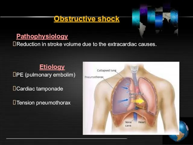 Obstructive shock Pathophysiology Reduction in stroke volume due to the