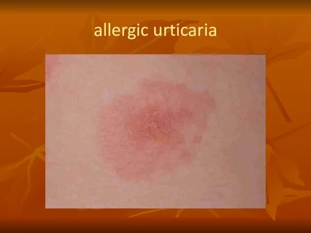 allergic urticaria