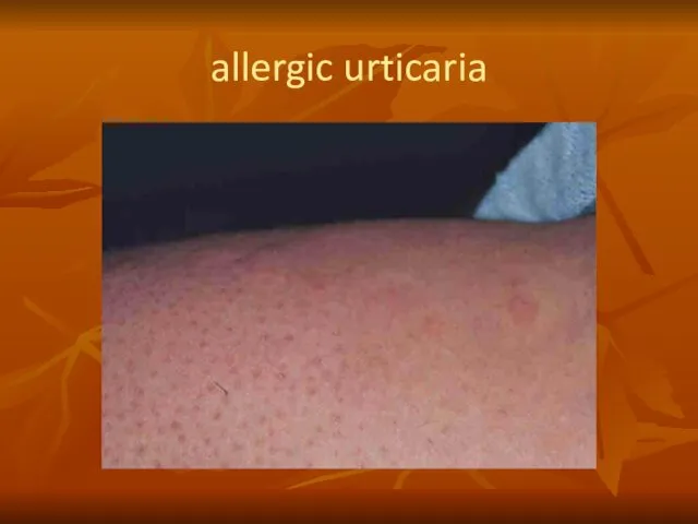 allergic urticaria