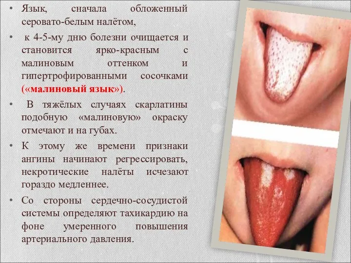 Язык, сначала обложенный серовато-белым налётом, к 4-5-му дню болезни очищается