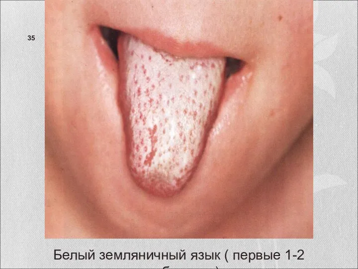 Белый земляничный язык ( первые 1-2 дня болезни).