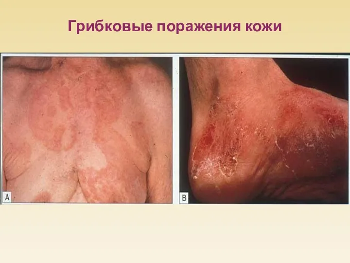 Грибковые поражения кожи