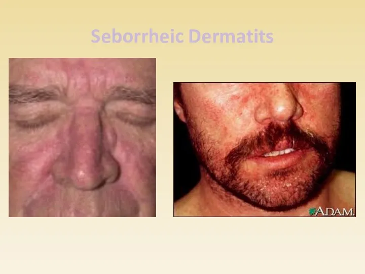 Seborrheic Dermatits