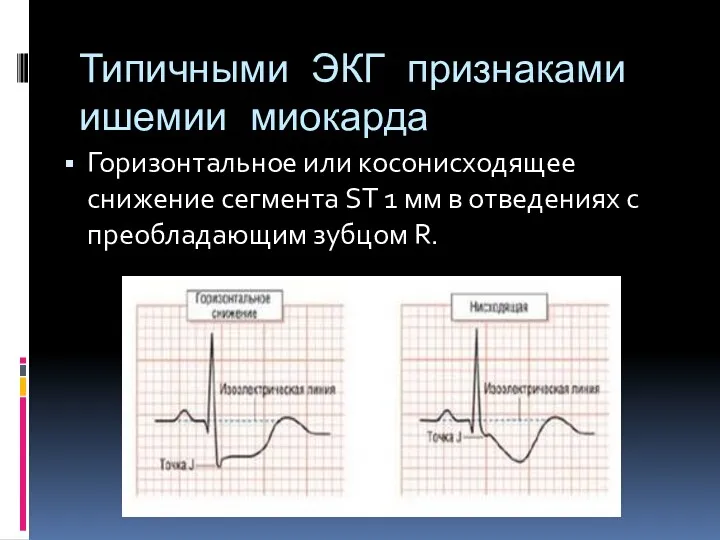 Типичными ЭКГ признаками ишемии миокарда Горизонтальное или косонисходящее снижение сегмента