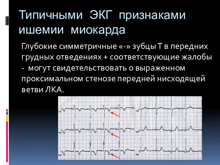 Типичными ЭКГ признаками ишемии миокарда Глубокие симметричные «-» зубцы Т