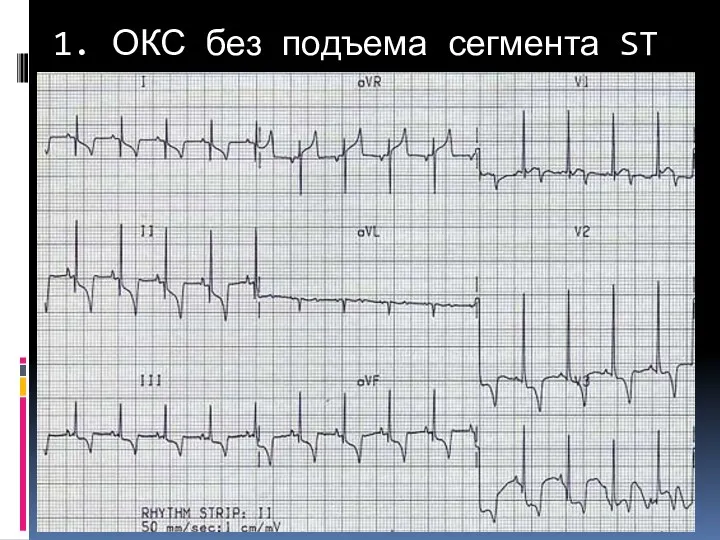 1. ОКС без подъема сегмента ST