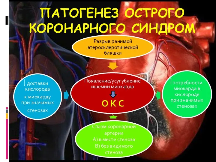 ПАТОГЕНЕЗ ОСТРОГО КОРОНАРНОГО СИНДРОМ