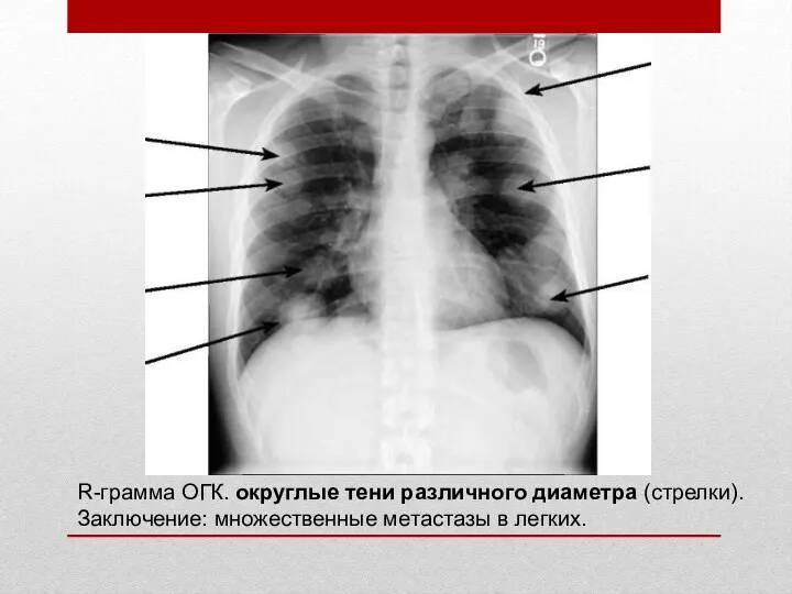 R-грамма ОГК. округлые тени различного диаметра (стрелки). Заключение: множественные метастазы в легких.