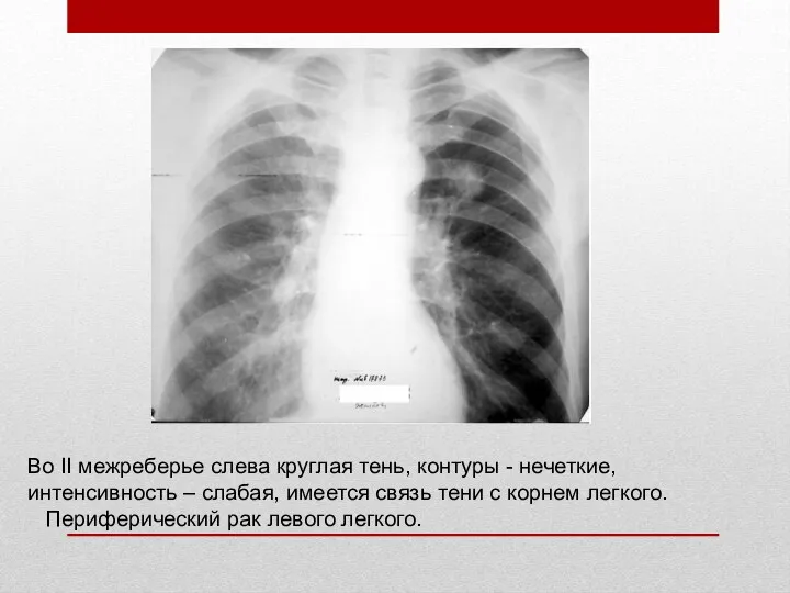 Во II межреберье слева круглая тень, контуры - нечеткие, интенсивность