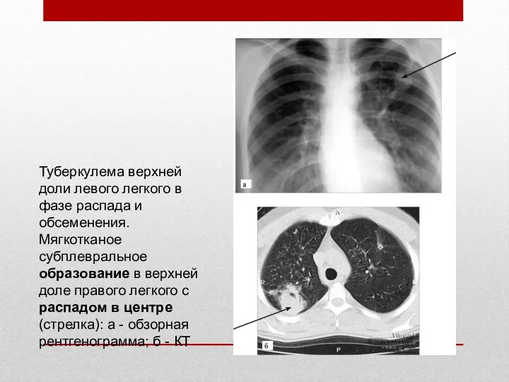 Туберкулема верхней доли левого легкого в фазе распада и обсеменения.