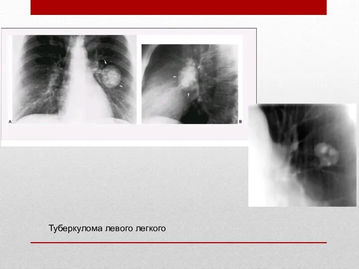 Туберкулома левого легкого