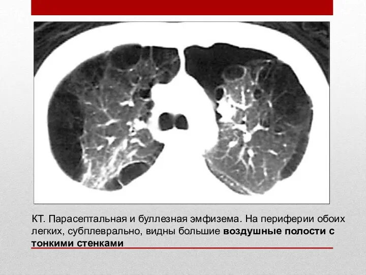 КТ. Парасептальная и буллезная эмфизема. На периферии обоих легких, субплеврально,