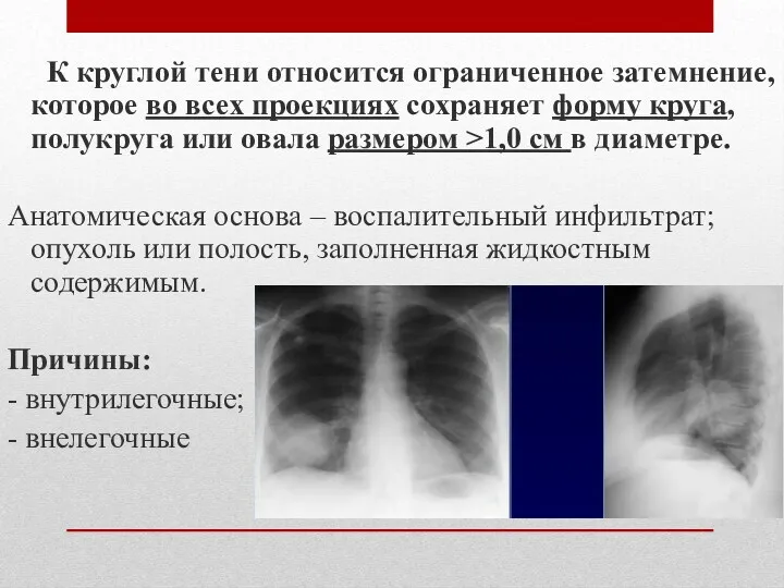 К круглой тени относится ограниченное затемнение, которое во всех проекциях