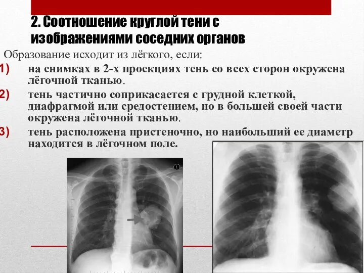 2. Соотношение круглой тени с изображениями соседних органов Образование исходит