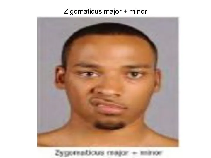 Zigomaticus major + minor