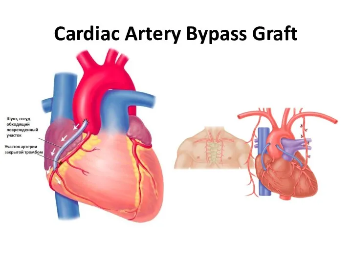 Cardiac Artery Bypass Graft