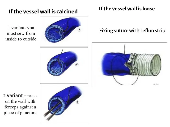 If the vessel wall is calcined If the vessel wall