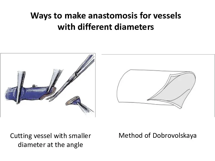 Ways to make anastomosis for vessels with different diameters Cutting