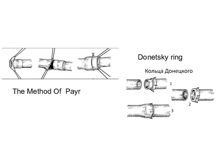 The Method Of Payr Donetsky ring