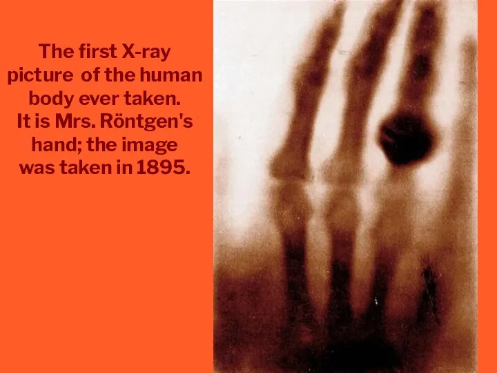 The first X-ray picture of the human body ever taken.