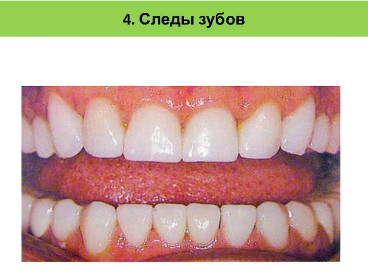 4. Следы зубов