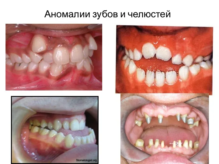 Аномалии зубов и челюстей