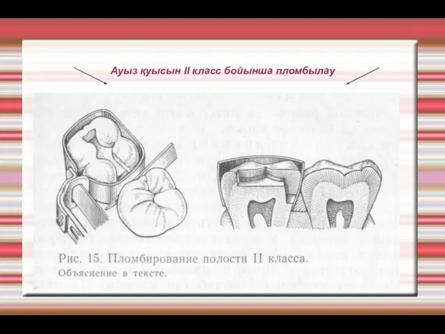 Ауыз қуысын ІІ класс бойынша пломбылау