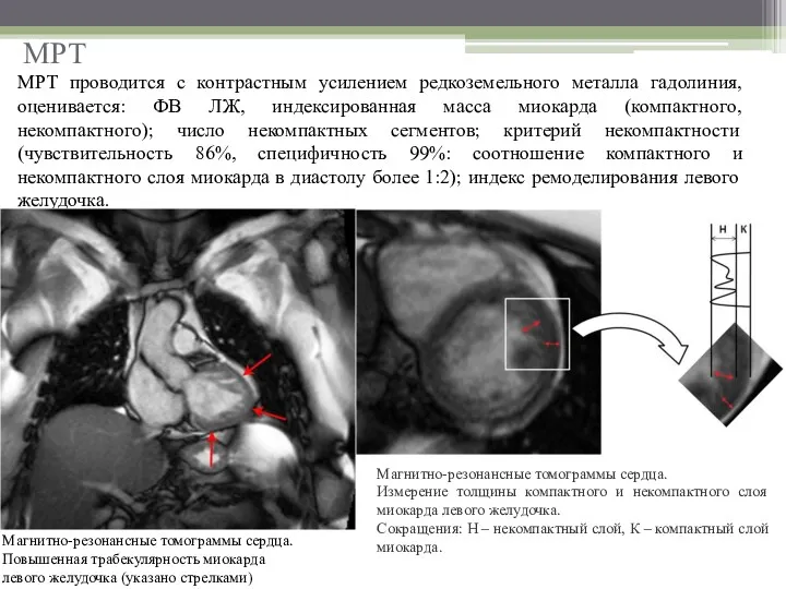 МРТ МРТ проводится с контрастным усилением редкоземельного металла гадолиния, оценивается: