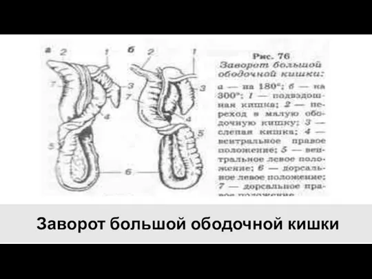 Заворот большой ободочной кишки