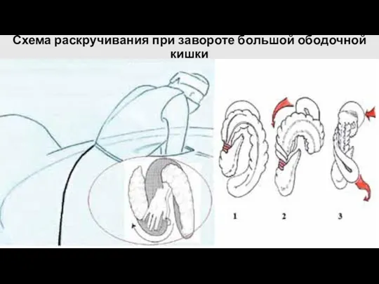 Схема раскручивания при завороте большой ободочной кишки