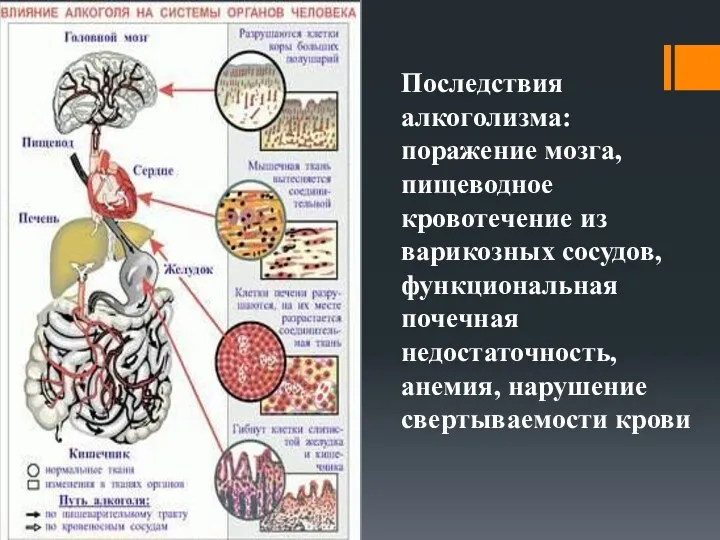 Последствия алкоголизма: поражение мозга, пищеводное кровотечение из варикозных сосудов, функциональная почечная недостаточность, анемия, нарушение свертываемости крови