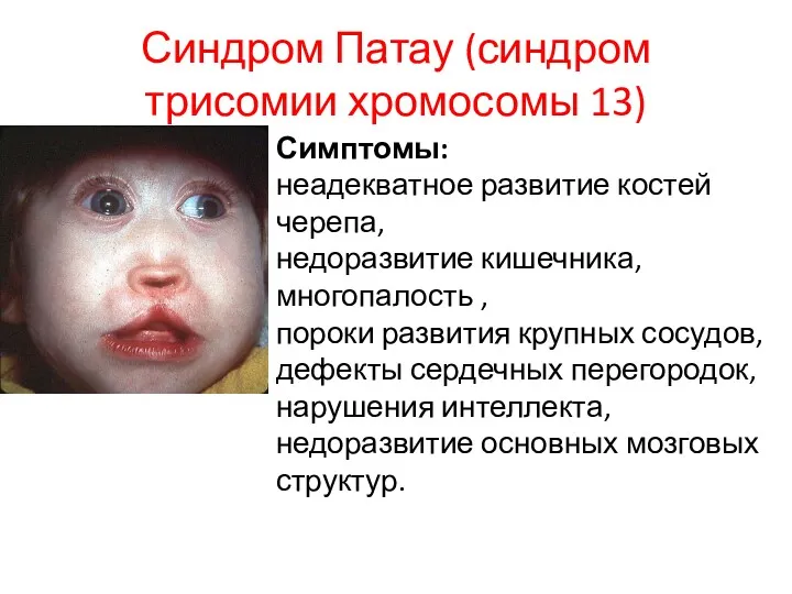 Синдром Патау (синдром трисомии хромосомы 13) Симптомы: неадекватное развитие костей