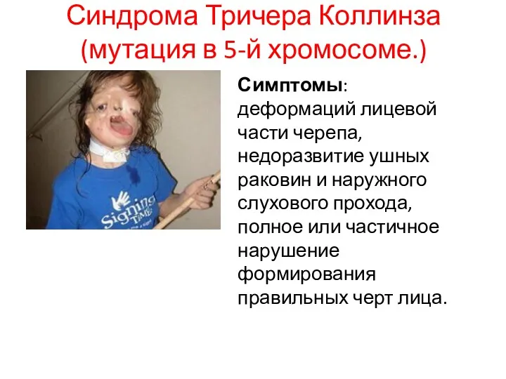 Синдрома Тричера Коллинза (мутация в 5-й хромосоме.) Симптомы: деформаций лицевой