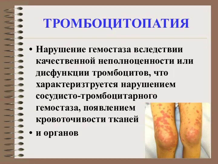 ТРОМБОЦИТОПАТИЯ Нарушение гемостаза вследствии качественной неполноценности или дисфункции тромбоцитов, что характеризтруется нарушением сосудисто-тромбоцитарного