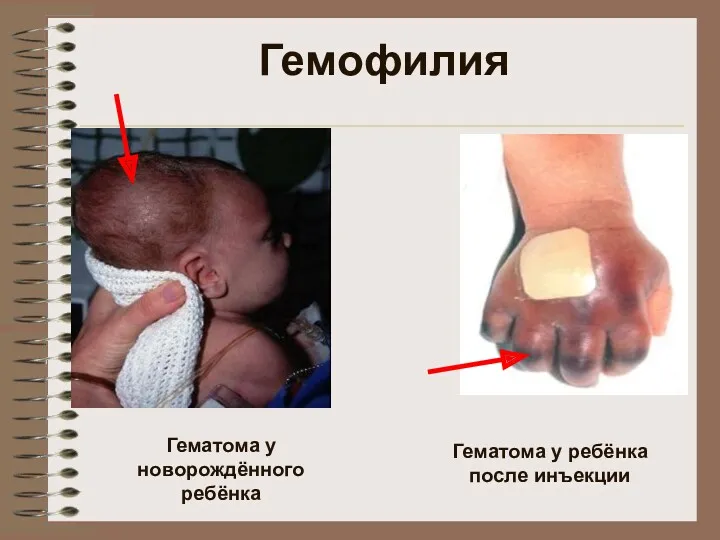 Гемофилия Гематома у новорождённого ребёнка Гематома у ребёнка после инъекции