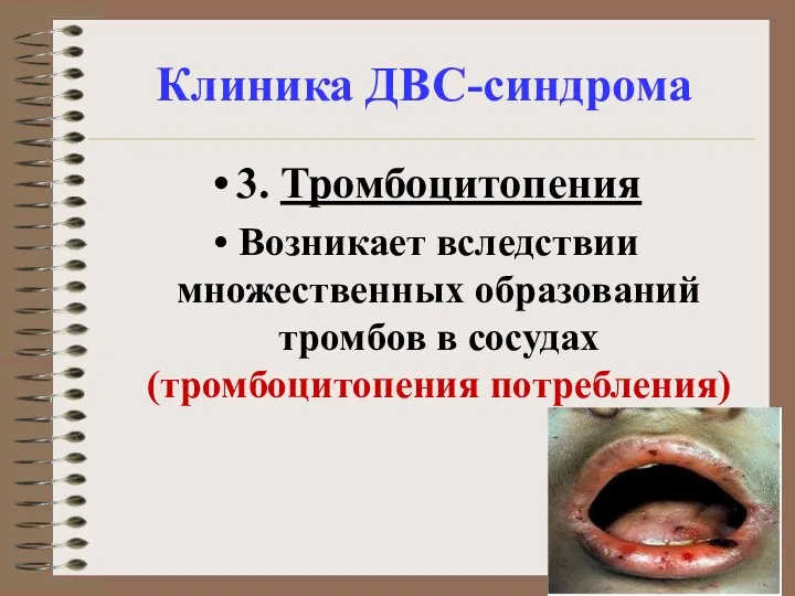 Клиника ДВС-синдрома 3. Тромбоцитопения Возникает вследствии множественных образований тромбов в сосудах (тромбоцитопения потребления)