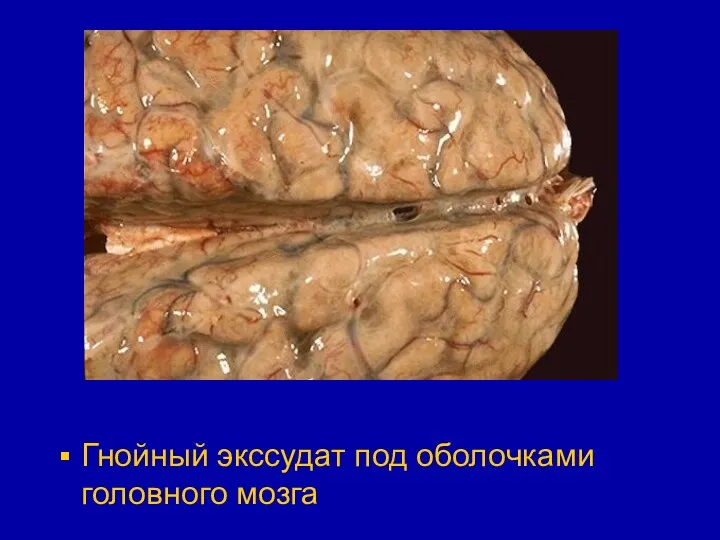Гнойный экссудат под оболочками головного мозга