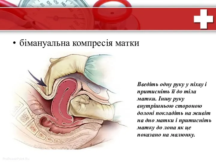 бімануальна компресія матки Введіть одну руку у піхву і притисніть