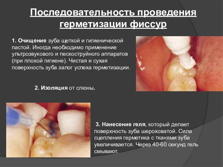 Последовательность проведения герметизации фиссур 1. Очищение зуба щеткой и гигиенической