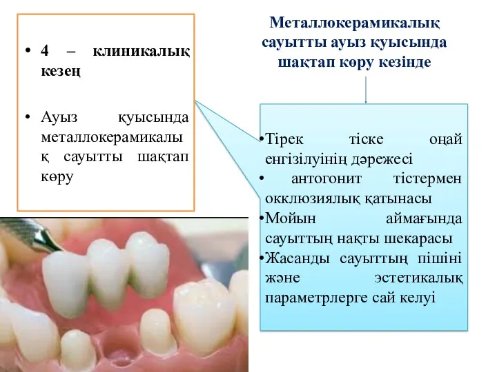 Металлокерамикалық сауытты ауыз қуысында шақтап көру кезінде Тірек тіске оңай енгізілуінің дәрежесі антогонит