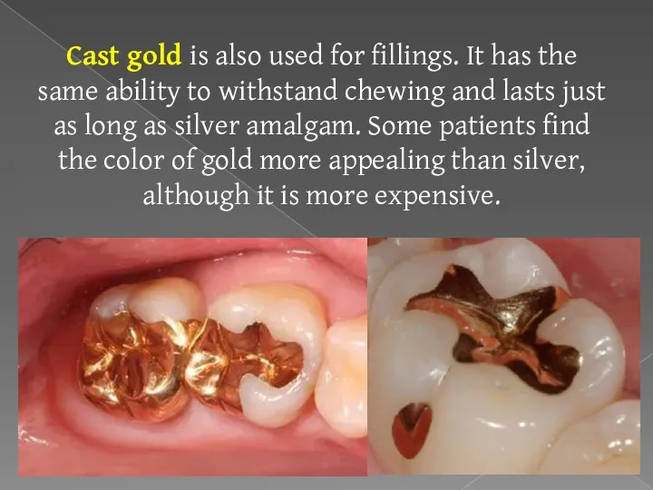 Cast gold is also used for fillings. It has the same ability to