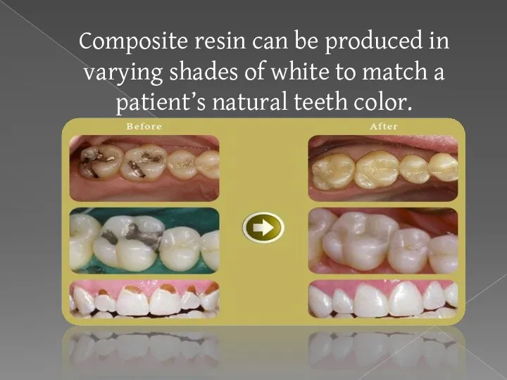 Composite resin can be produced in varying shades of white to match a