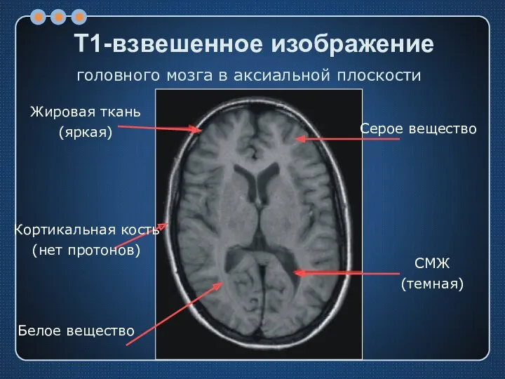 Т1-взвешенное изображение Жировая ткань (яркая) Кортикальная кость (нет протонов) Белое