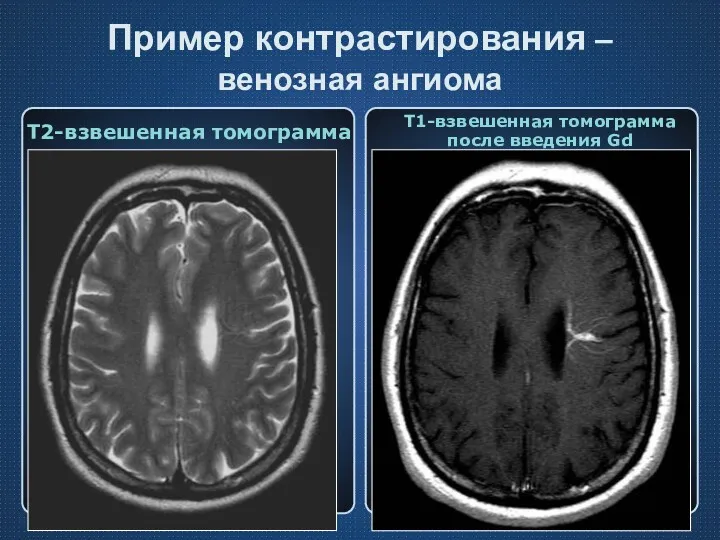 Пример контрастирования – венозная ангиома Т2-взвешенная томограмма Т1-взвешенная томограмма после введения Gd